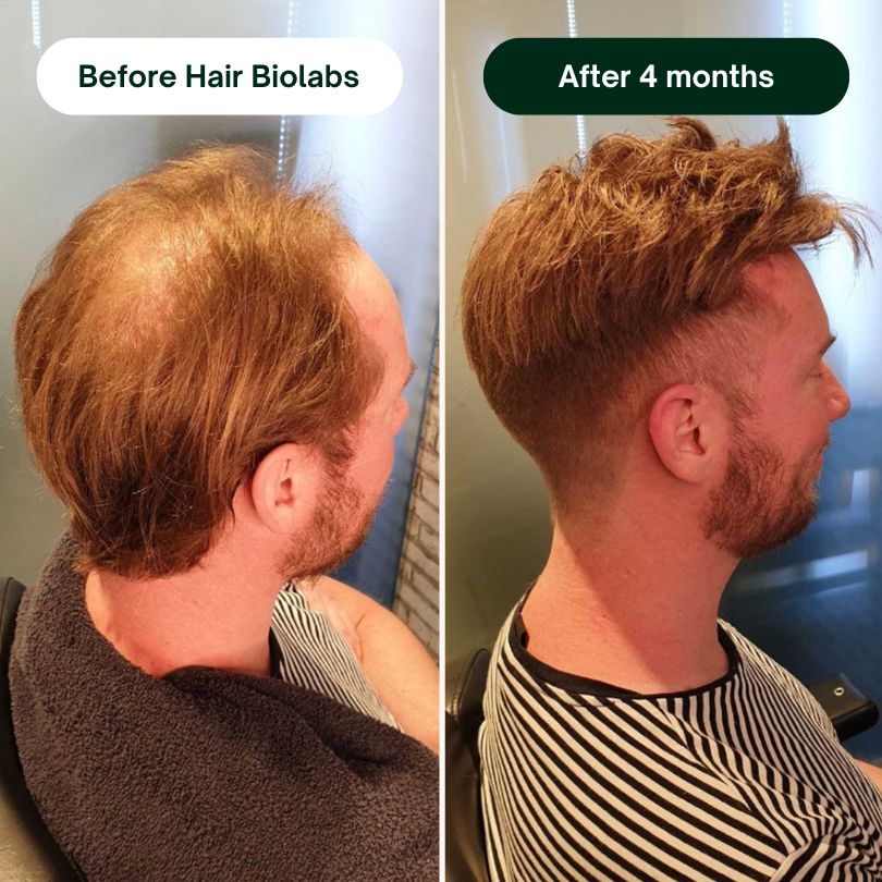 Hair Biolabs™ Hair Regrowth Micro-Infusion System