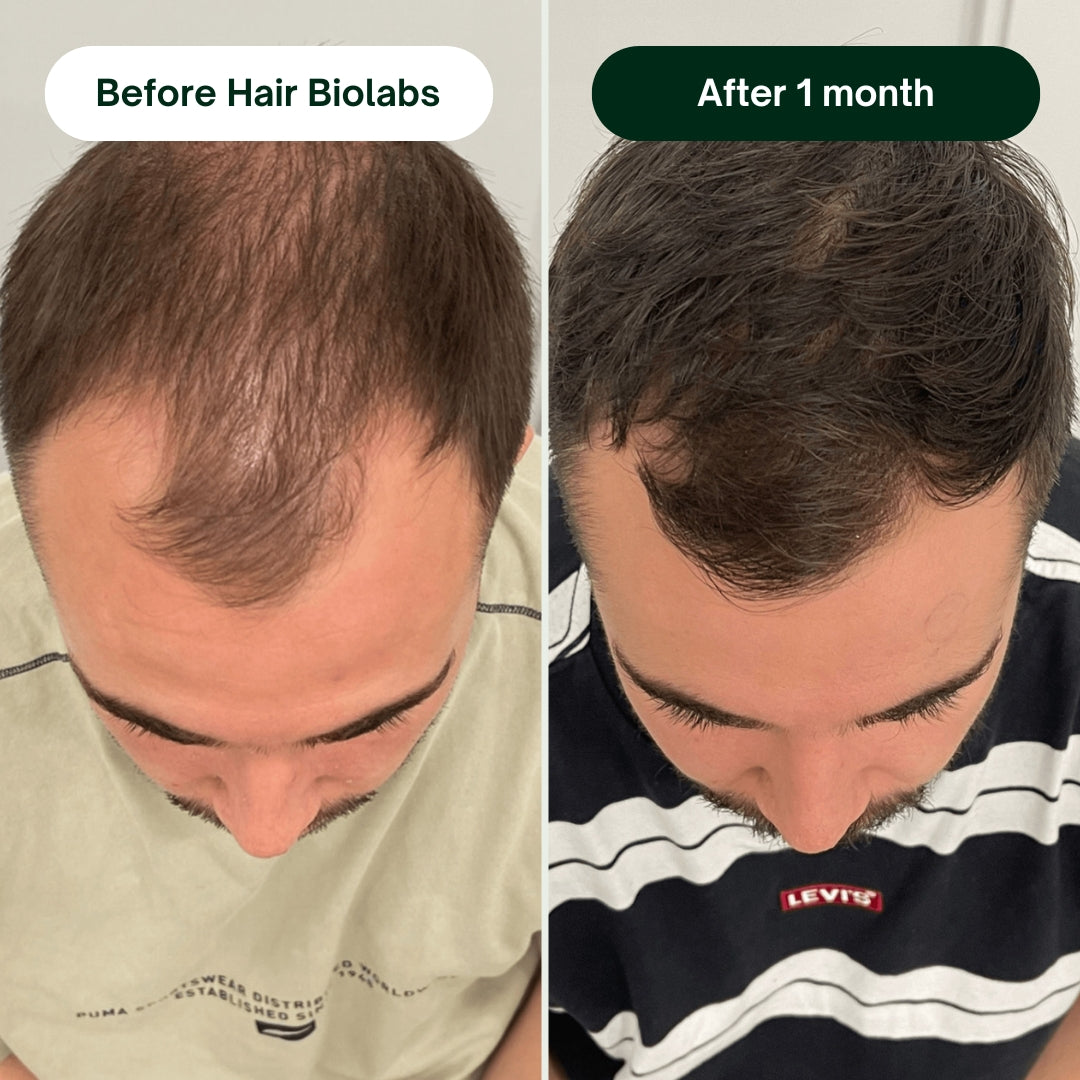 Hair Biolabs Hair Regrowth Micro-Infusion System