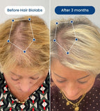 Clinical Regrowth Filler - Hair Biolabs™ Microneedling System