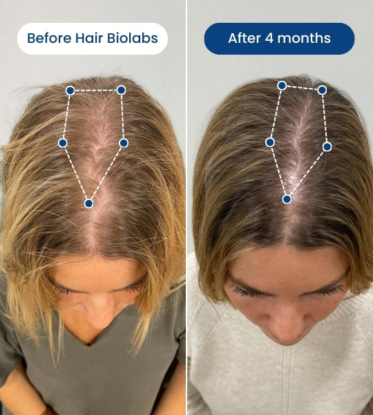 Clinical Regrowth Filler - Hair Biolabs™ Microneedling System