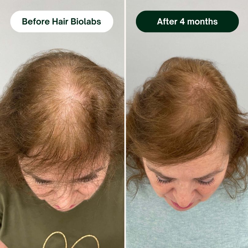 Hair Biolabs - Stops Hair Loss in 21 Days