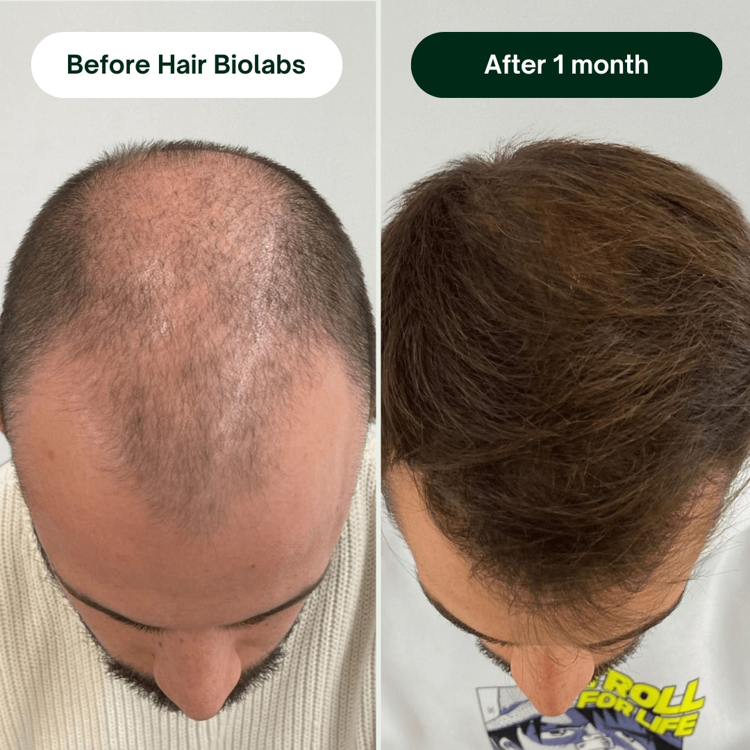 Hair Biolabs Hair Regrowth Micro-Infusion System