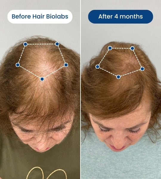 Clinical Regrowth Filler - Hair Biolabs™ Microneedling System
